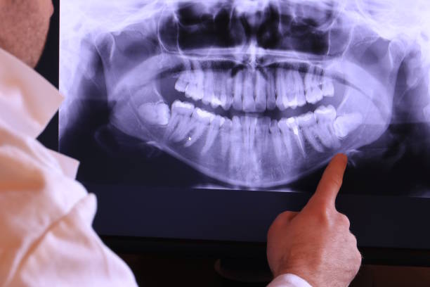 Best Emergency Wisdom Teeth Removal in Plumsteadville, PA